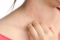 Mẹo giảm khó chịu do dị ứng thời tiết