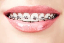 Sai lầm cần tránh khi niềng răng