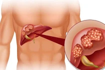Ảnh hưởng của rối loạn chuyển hoá đến chức năng gan