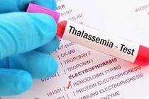 Hiểu đúng về bệnh tan máu bẩm sinh