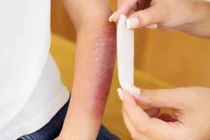 Mẹo điều trị, sơ cứu khi bị bỏng