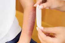 Cách sơ cứu, điều trị bỏng hiệu quả