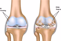 Bí quyết giảm đau xương khớp hiệu quả