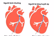 Đừng chủ quan với tăng huyết áp, hiểm họa không dấu hiệu