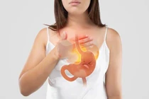 Trào ngược dạ dày có thể biến chứng thành ung thư thực quản