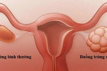 Đừng chủ quan với buồng trứng đa nang