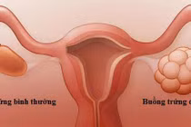 Buồng trứng đa nang, hiểm họa sức khỏe dễ bị bỏ qua