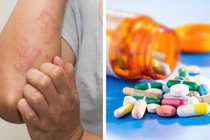 Dị ứng kháng sinh, tai biến y khoa ai cũng có thể gặp