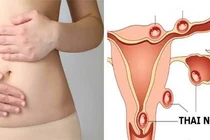 Vì sao chửa ngoài tử cung thường bị nhầm với sảy thai sớm?