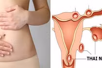 Ngăn chặn chửa ngoài tử cung từ sớm với 7 thói quen đơn giản