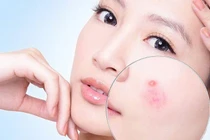 Giải pháp ngăn ngừa mụn hiệu quả