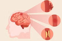 Phục hồi chức năng sau tai biến mạch máu não