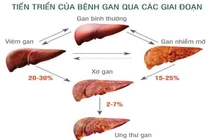 Không rượu, người trẻ vẫn bị gan nhiễm mỡ