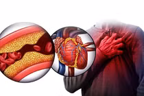 Mỡ trong máu, nguy cơ không thể xem thường