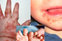 Cách phòng ngừa bệnh chân tay miệng