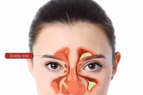 Cách phòng viêm xoang tái phát