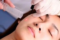 Tẩy nốt ruồi bằng laser, những điều cần biết để tránh sẹo