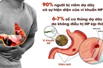 Sự thật ít biết về vi khuẩn HP