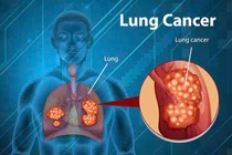 Giới trẻ và nguy cơ mắc ung thư phổi và trực tràng sớm