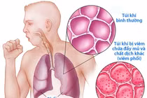 Cách phòng ngừa biến chứng nguy hiểm của viêm phổi