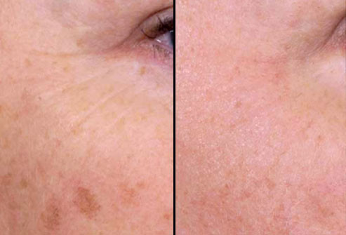 Trước và sau điều trị bằng Laser Nonablative: Điều trị bằng Laser Nonablative là một lựa chọn tốt cho những người muốn cải thiện cả màu và kết cấu da mà không phải nghỉ việc. Mỗi lần điều trị có thể gây đỏ nhẹ, nhưng sẽ khỏi nhanh chóng. Để có kết quả tốt nhất, nên điều trị 4 - 6 lần, mỗi lần cách nhau vài tuần.
