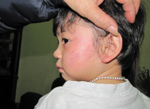 4. Thước và roi: Đây cũng là 2 dụng cụ phổ biến mà các bảo mẫu dùng để đánh đập trẻ. Hồi giữa tháng 3/2012, tại Trường mầm non Hoàng Thị Loan, phường Bến Thủy, thành phố Vinh, Nghệ An, b é Nguyễn Thị Khánh Linh đã bị cô giáo dùng thước đánh thâm tím mặt.