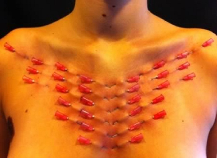 Gim hàng chục mũi tiêm hướng thẳng vào tim