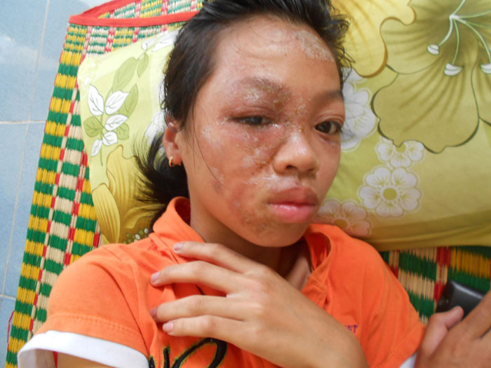 Trong ảnh là cháu Hoàng Thị Ngọc Hạnh ở Huế trong lúc đang ngủ bị kiến ba khoang đốt, gây phỏng rộp, viêm da. Vùng phỏng này ngày 1 lan rộng khiến nạn nhân sốt, đau nhức, khuôn mặt sưng húp, phải điều trị cả tuần ở bệnh viện.