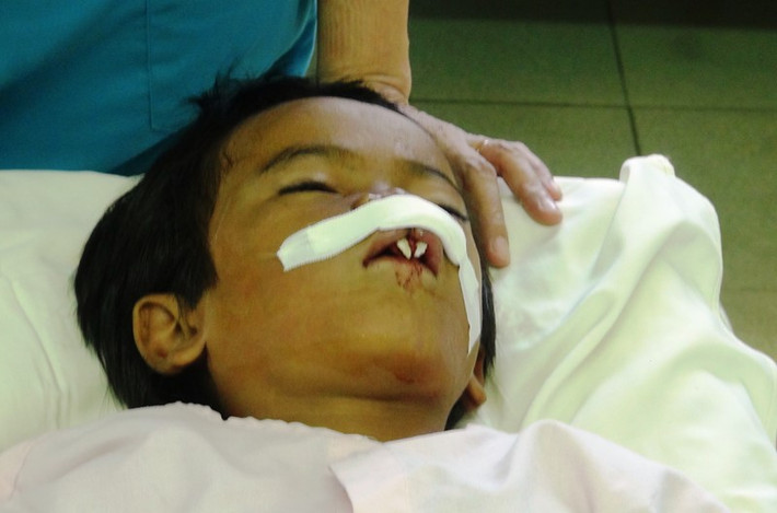 Sau phẫu thuật, Nghiệp sẽ được các bác sĩ giữ lại 5 ngày tại Bệnh viện để theo dõi tình hình sức khỏe.