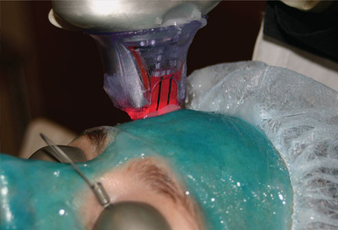 Điều trị không tổn thương bằng laser (Laser Nonablative - Fraxel): Đây là loại điều trị thâm nhập dưới bề mặt da mà không làm tổn hại đến lớp ngoài của da. Loại điều trị này kích thích sản xuất collagen, làm giảm nếp nhăn, cải thiện và săn chắc da. Liệu pháp này có thể gây đau, vì vậy có thể bạn phải gây tê tại chỗ. Vì laser nonablative không làm hỏng bề mặt da nên không cần thời gian phục hồi.