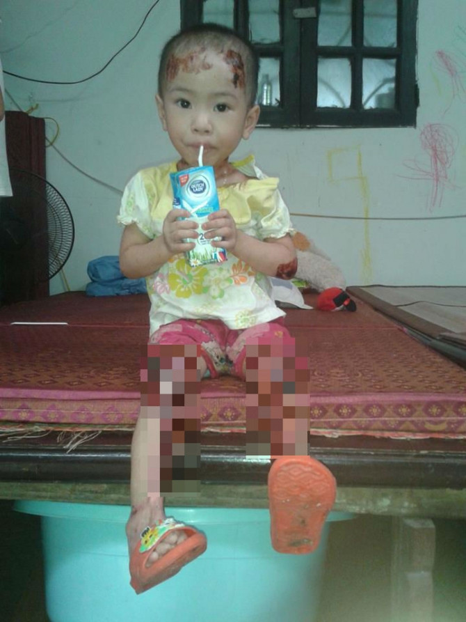 Thế nhưng ở chùa Bồ Đề có trường hợp bé Tâm Anh bị bệnh ly thượng bì bóng nước, dòi bu đầy chân, đe dọa tính mạng, vậy mà khi một nhóm thiện nguyện tới đây, xin cho bé đi bệnh viện để trị bệnh thì sư Đàm Lan không đồng ý, nói sang UBND phường hỏi ý kiến, phường lại đùn trách nhiệm sang phía công an. Một thành viên nhóm thiện nguyện này kể: "Chúng tôi đã lôi con ra từ gầm cầu thang. Con bị đặt ở đấy, đợi chết, chắc vì ai cũng nghĩ con sẽ không sống nổi nữa".