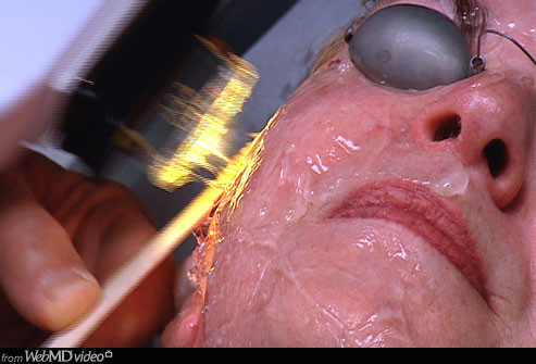 Công nghệ xung ánh sáng (IPL): Như laser, IPL đi dưới lớp sâu hơn của da được gọi là hạ bì. Các xung ánh sáng ngắn làm nóng và tiêu diệt các tế bào mục tiêu và kích thích trẻ hóa. Không giống như laser, IPL cung cấp một loạt các ánh sáng có thể điều trị nhiều loại da không hoàn hảo cùng một lúc và chỉ gây ra cảm giác vừa phải.