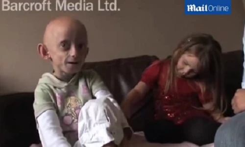 Cô bé 11 tuổi có khuôn mặt như bà lão 80