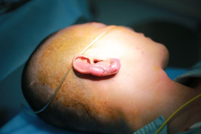 Tiêm filler để có tai Phật, ai ngờ thành… tai thối - Hình 2 Tiem filler de co tai Phat, ai ngo thanh… tai thoi-Hinh-2