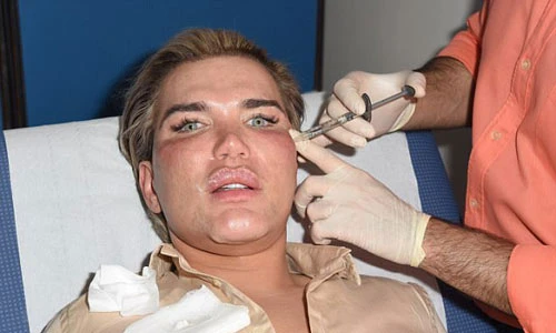 Cận cảnh 3 tiếng tiêm botox của búp bê sống Ken Doll