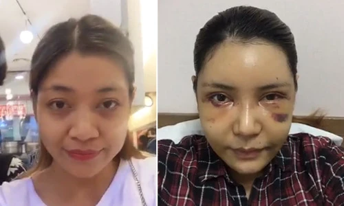 Á quân Xuân Nghi khoe mặt tím bầm sau dao kéo