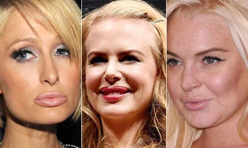 Nhận diện những ngôi sao bơm môi