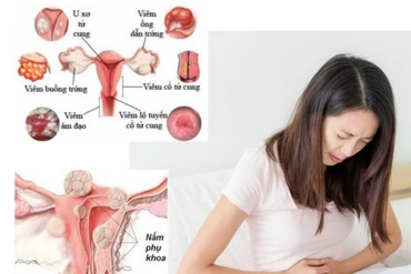 Các bệnh phụ khoa thường gặp ở phụ nữ trẻ