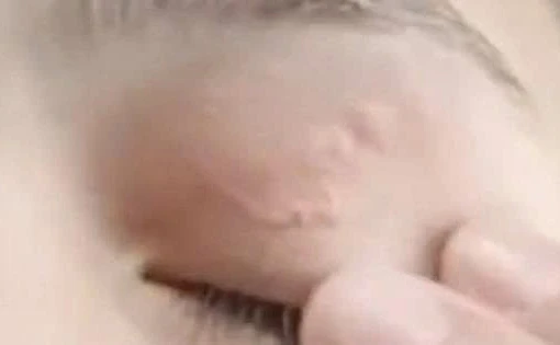 Kí sinh trùng 11cm làm tổ ở mí mắt cô gái 26 tuổi
