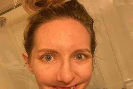 Vì sao cô gái đột nhiên bị rụng răng như bà lão?