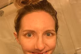 Vì sao cô gái đột nhiên bị rụng răng như bà lão?