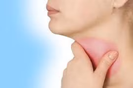 4 kiểu ăn uống dẫn đến ung thư thực quản