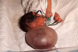 Hoảng hốt khi bé gái sơ sinh “mọc” quả bóng khổng lồ ở mặt
