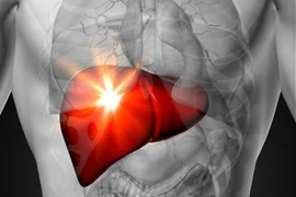 Có dấu hiệu này chứng tỏ bạn đang bị gan nhiễm mỡ