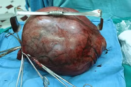 Choáng váng với khối u xơ tử cung “khổng lồ“ nặng 8kg