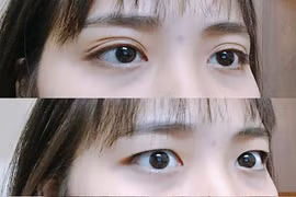 Các "mắt ngàn mí" kêu than chuyện mí mắt "biến hóa khôn lường"