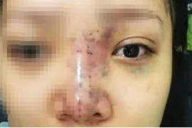 Công an vào cuộc vụ spa tiêm filler làm nữ sinh 20 tuổi mù mắt