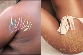 Chị em thích thú trào lưu hô biến vết rạn trên cơ thể