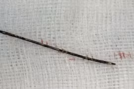Phẫu thuật lấy kim khâu dài 4cm nằm 2 năm trong ngực bé gái