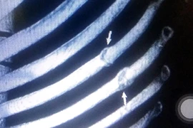 Bắc Ninh: Đánh cán bộ nhà thầu vì...tiền hỗ trợ không thỏa đáng